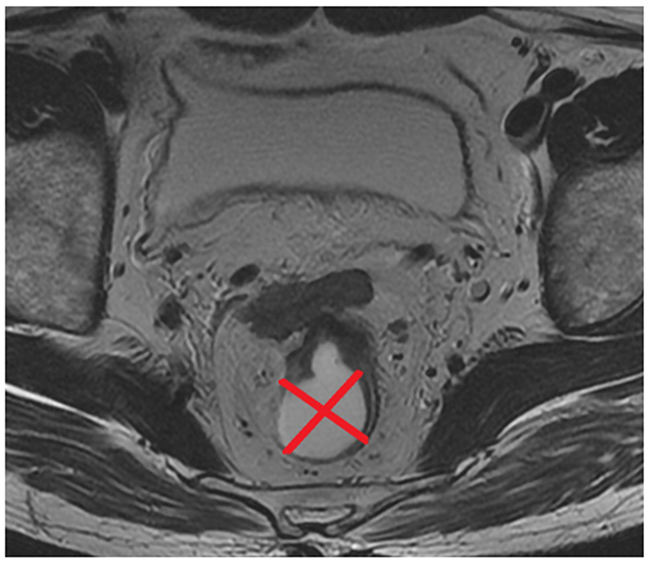 Two orthogonal lines that passed through the perceived centre of the lumen divided the rectal wall into four groups of tumor position (TP).