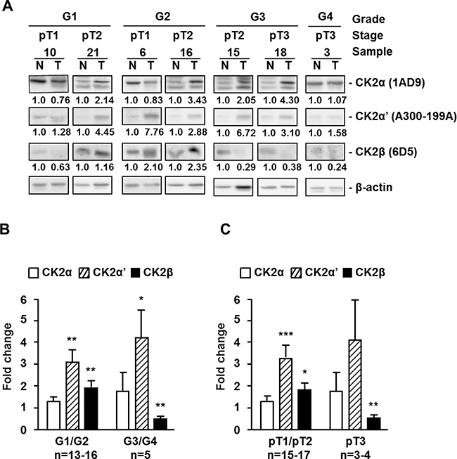 Protein kinase CK2 subunits expression in different extracts of human ccRCC biopsies.