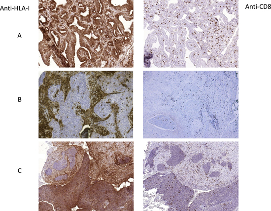 Representative images of tumor HLA-I expression and CD8+ T-cell infiltration patterns.