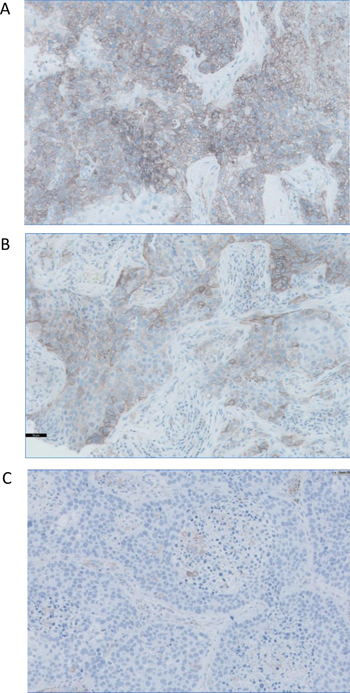 Figure 2:. Representative images of three paraffin-embedded tumors with different patterns of PD-L1 expression.