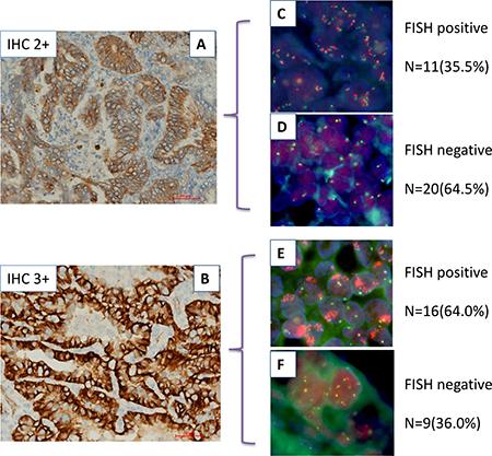 Relationship between c-MET protein expression and MET gene copy number in lung adenocarcinoma by IHC and FISH.