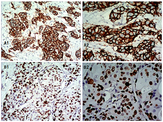 Positive expression of HER-2 and Ki-67 in invasive breast cancer as shown by IHC.