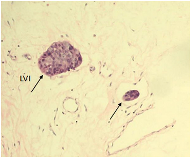 Tumor LVI (single arrows) in a section of invasive breast cancer stained with H&E at 200x magnification.