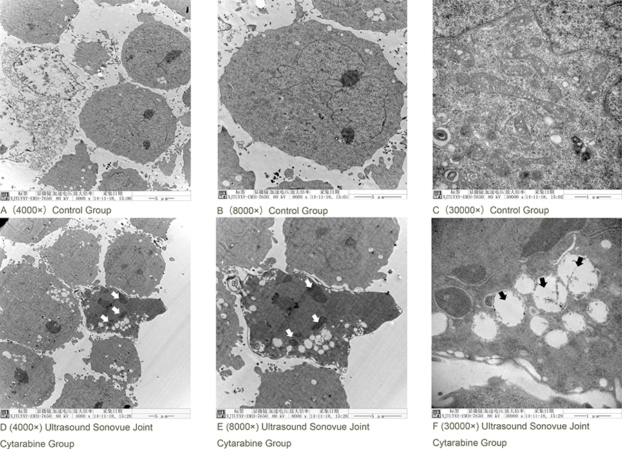 Ultrasound Sonovue&#x00AE; joint Cytarabine intervention in k562 cells in electron microscope.