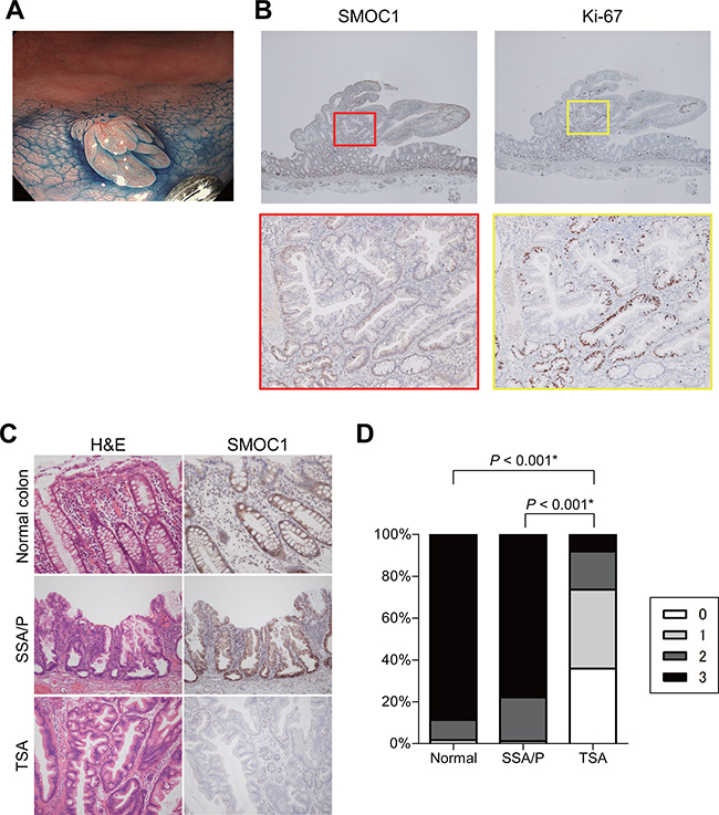 Immunohistochemical analysis of SMOC1 in serrated lesions.