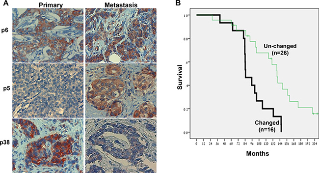 Discordance of heparanase staining in primary vs metastatic breast cancer.