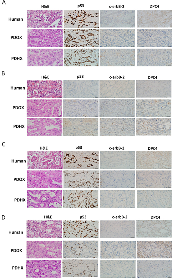 Immunohistochemistry analysis of the original patient tumors compared with patient-derived xenografts PDOX and PDHX.