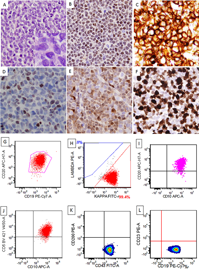A representative case of CD10+ mantle cell lymphoma, blastoid variant.