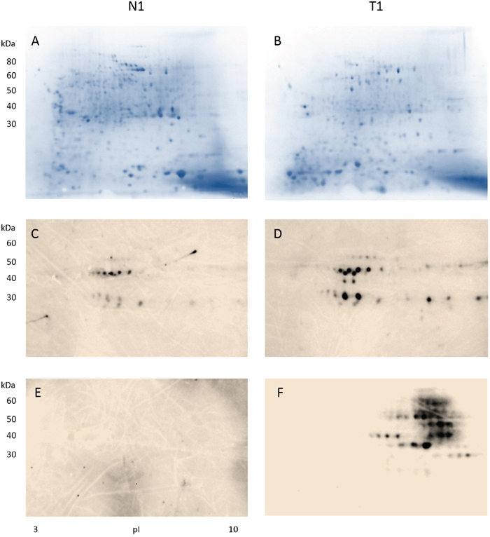 Detection of antibody-reactive proteins in colon tissue extracts from a male patient with stage II colon adenocarcinoma.