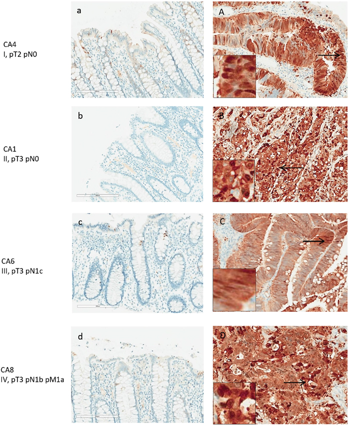 Maspin expression in normal and adenocarcinoma colon tissue by IHC.