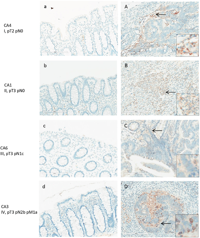 ANXA3 expression in normal and adenocarcinoma colon tissue by IHC.