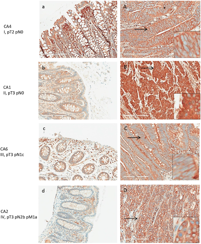 LAP3 expression in normal and adenocarcinoma colon tissue by IHC.