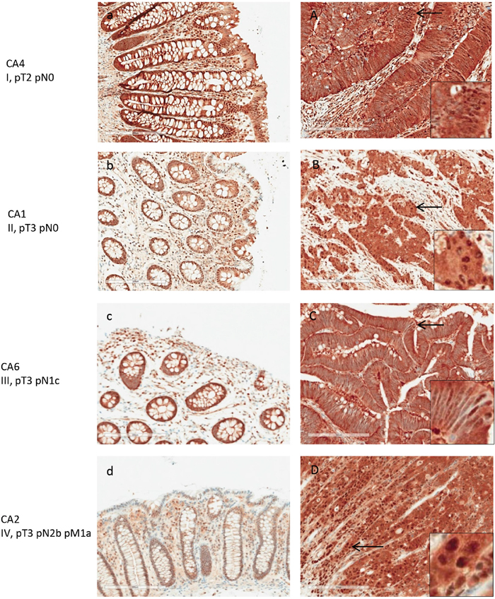 PSMA1 expression in normal and adenocarcinoma colon tissue by IHC.