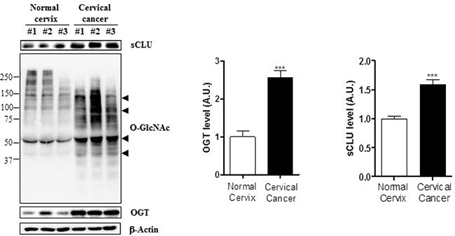 Expression of sCLU, O-GlcNAc, and OGT is increased in cervical cancer tissue.