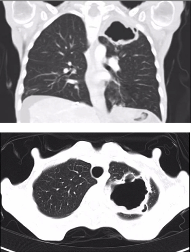 Pneumatocele in the upper left lobe (55 &#x00D7; 38 &#x00D7; 44 mm) (Case 1).