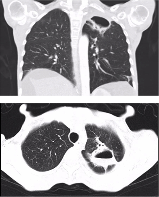 Lung cavity improvement after discontinuing Sorafenib treatment (27 &#x00D7; 28 &#x00D7; 42 mm) (Case 1).