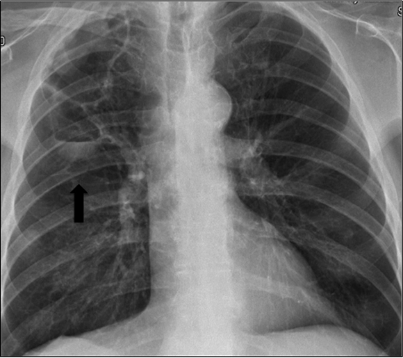 Pneumatocele enlargement detected in chest X-ray (black arrow) (Case 2).