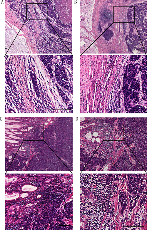 In gastric cardia NECs, some cases were mixed with mucinous adenocarcinoma, and with a clear border (A, B).