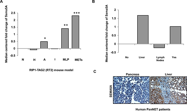 Sema5A expression is higher in metastasis in comparison with normal islets in PanNET.