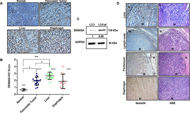 Expression of SEMA5A progressively increases at metastatic sites of PC.