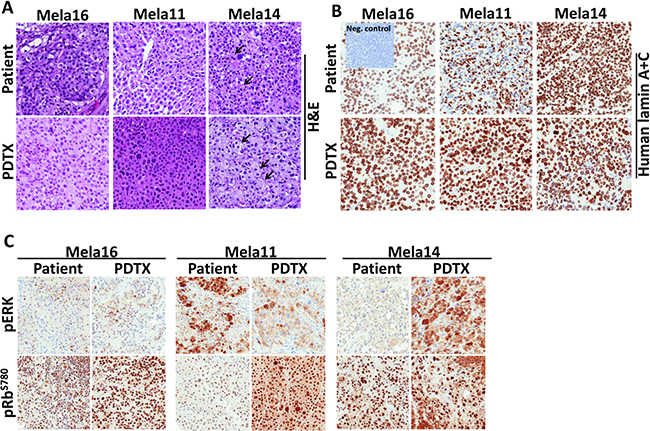 Phenotypic and genetic comparison showed PDTX matched parental patient tumor tissue.