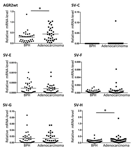 Expression level of AGR2 splice variants in benign and prostate cancer.
