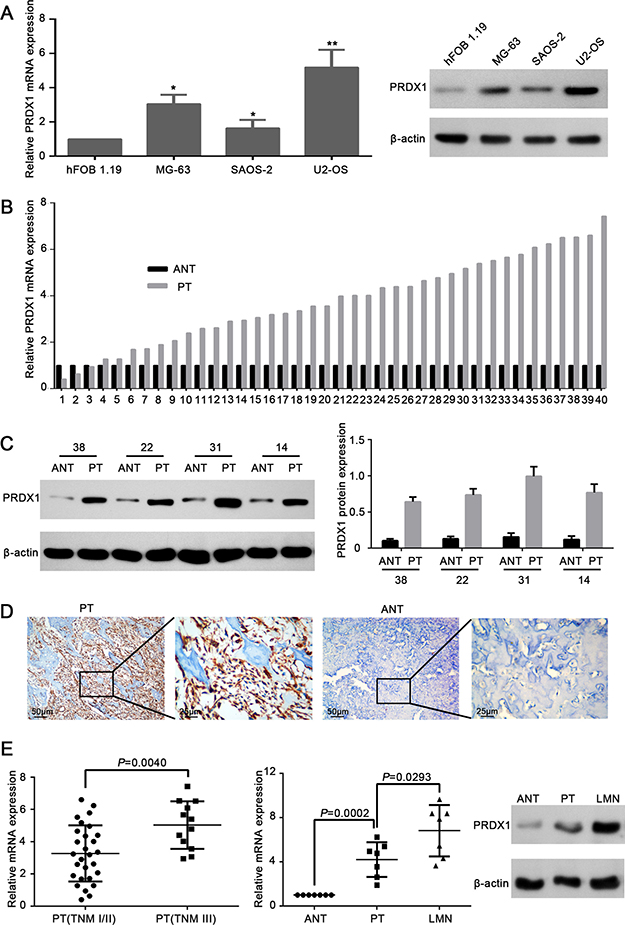 Expression level of PRDX1 elevates in human osteosarcoma tissues and cell lines.