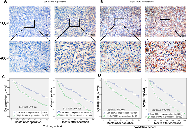 Expression level of PRDX1 is associated with poor prognosis of osteosarcoma patients.