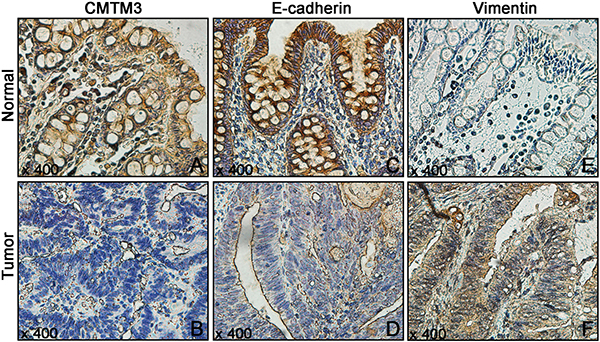The protein expressions of CMTM3 and EMT-related proteins (E-cadherin and Vimentin) in 130 CRC tissues and their corresponding NATs were detected using IHC.