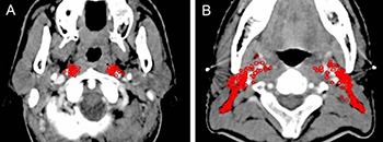 Lymph node distribution pattern of retropharyngeal lymph nodes.