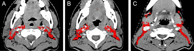 Lymph node distribution patterns of Level II lymph nodes.