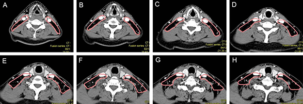 Proposed CTV delineation protocol for Level V lymph nodes.