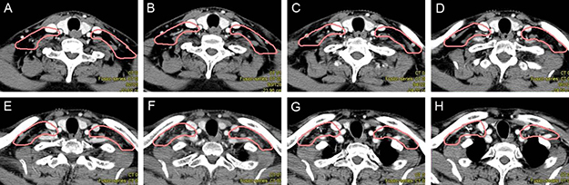 Proposed CTV delineation protocol for supraclavicular lymph nodes.