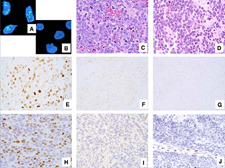 Examples of neuroblastoma, undifferentiated and poorly differentiated subtype with a High Mitosis-Karyorrhexis Index.