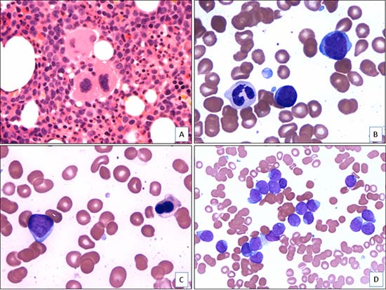 Morphologic features of AML with t(4;12)(q12;p13) (case 5).