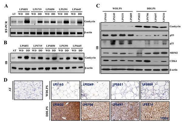 Comparison of protein expression levels in WDLPS and DDLPS.