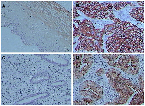 Uc.189 levels were stained by in situ hybridization in cervical squamous cell carcinomas (CSCC) and endometrial adenocarcinomas (EAC).