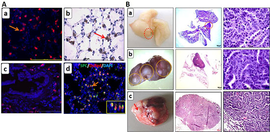 Genetic lineage labeling marks alveolar type II cells with DsRed in the non-neoplastic lungs while tumors were generated in the neoplastic lungs of the reporter transgenic mice.