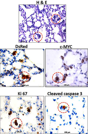 Occurrence of unique premalignant lesions in the lungs of metastatic transgenic reporter mice.