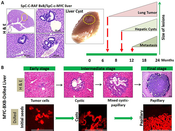 Hepatic cysts represent the early stage of metastasis in NSCLC as revealed by lineage tracing.