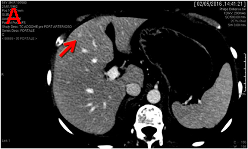 Computed tomography (CT) scan performed on April 2016 shows three liver lesions (LLs) in arterial phase.