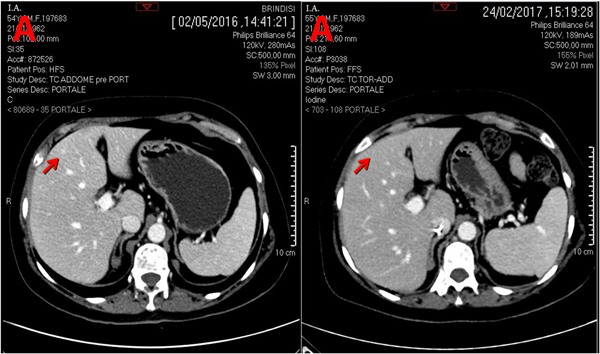 CT scan (portal phase) performed before and after hepatic artery infusion plus systemic chemotherapy.