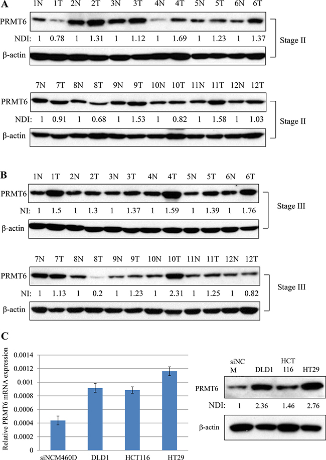Overexpression of PRMT6 in CRC tissues and cell lines.