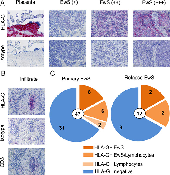 HLA-G is expressed in the tumor microenvironment of EwS patients.