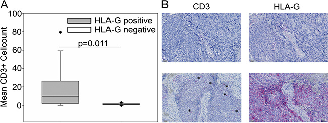 CD3+ T cell infiltration in HLA-Gpos EwS tumors is significantly enhanced compared to HLA-Gneg biopsies.