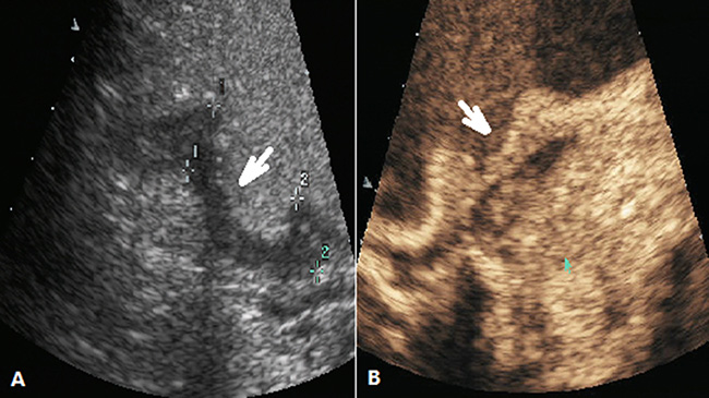 DCEUS images of a case classified as Borrmann type II .