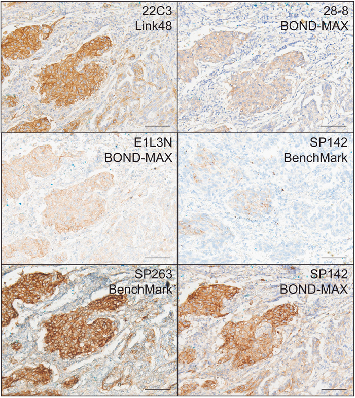 Representative IHC stains of PD-L1 in NSCLC using 22C3/Link48, 28-8/BOND-MAX, E1L3N/BOND-MAX, SP142/BenchMark, SP263/BenchMark, and SP142 BOND-MAX protocols.