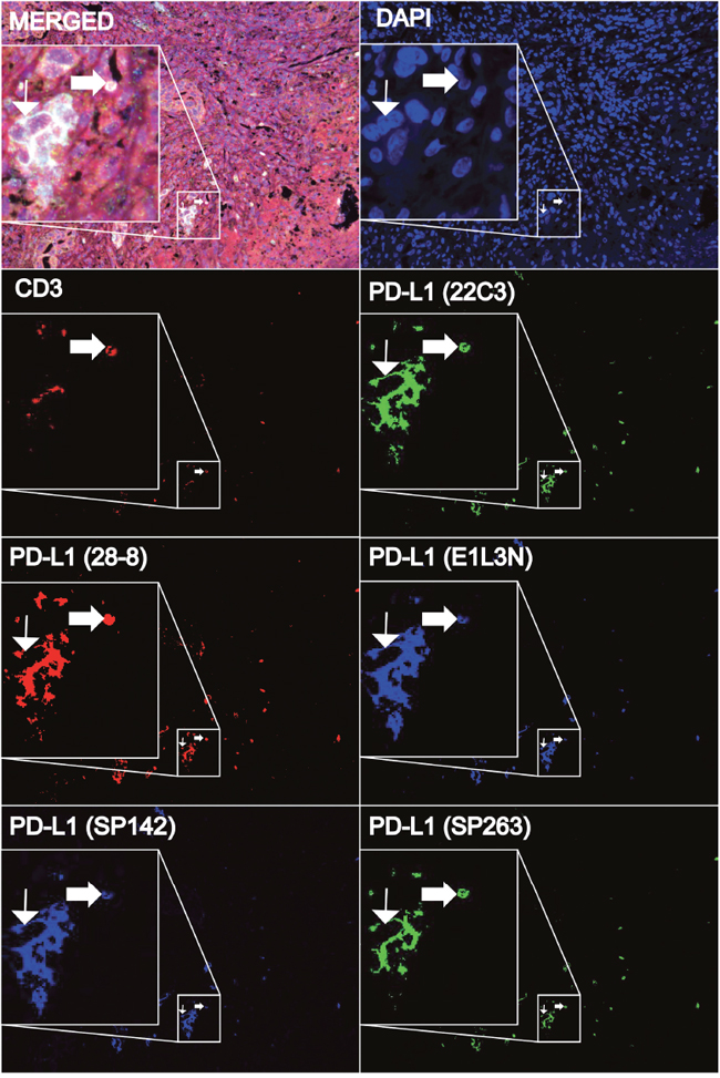 Representative multimarker fluorescence staining of NSCLC tissue samples using DAPI, CD3, and five PD-L1 antibodies (22C3, 28-8, E1L3N, SP142, and SP263) to assess their co-localization.