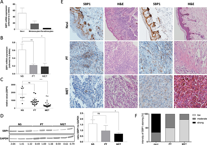 SELENBP1 in vivo in human melanoma (patient).