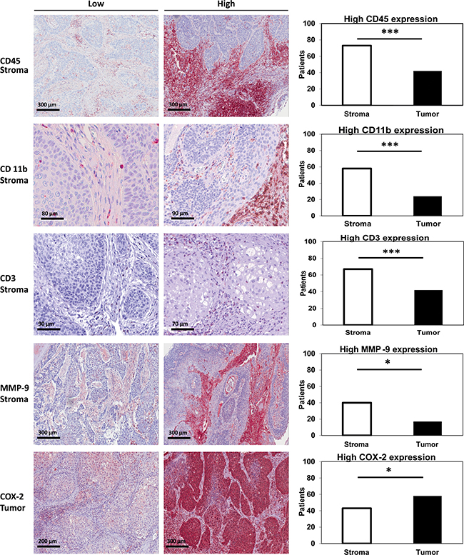 Stromal vs. tumoral expression of CD45/CD11b/CD3/MMP-9 and COX-2.